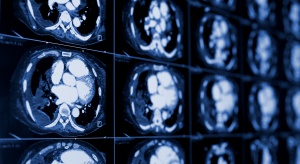 Urazowe uszkodzenie mózgu związane z chorobą Parkinsona
