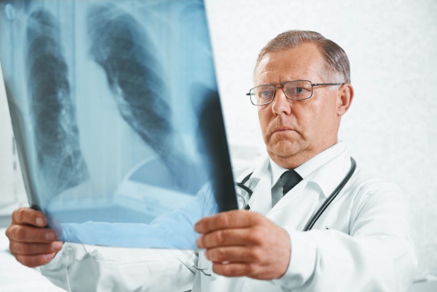 Eksperci: zaawansowany rak płuca dla części chorych jest chorobą przewlekłą