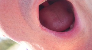 Bakterie z jamy ustnej sprzyjają wystąpieniu udaru? 