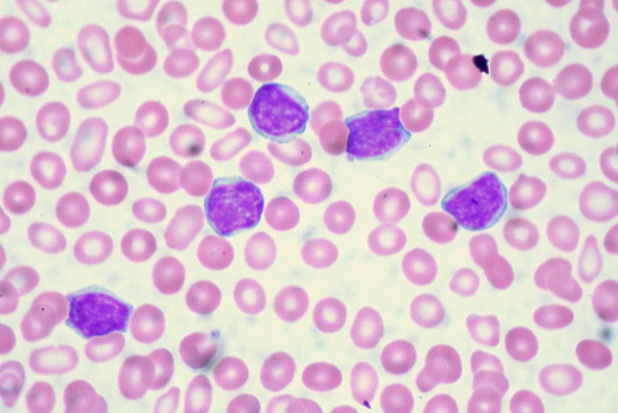 Z wiekiem rośnie ryzyko zachorowania na białaczkę limfocytową