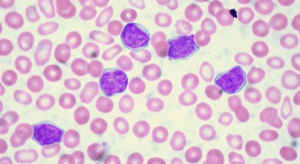 Eksperci: na przewlekłą białaczkę limfocytową zapada się najczęściej po sześćdziesiątce