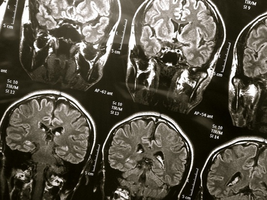 Diagnostyka osoby z podejrzeniem choroby Alzheimera zaczyna się u psychiatry lub neurologa. Fot. wyinoue/Flickr.com (CC BY 2.0) We Wrocławiu jest zbyt mało ośrodków opieki i terapii alzheimera