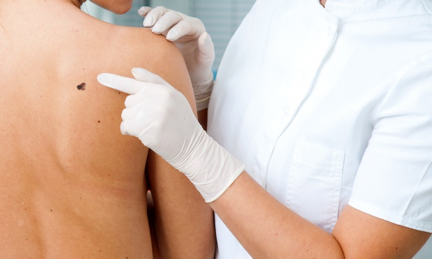 Będzie można skonsultować z dermatologiem wygląd podejrzanych znamion. Fot. Fotolia Śląskie: szereg darmowych badań i porad przed Dniem Walki z Rakiem
